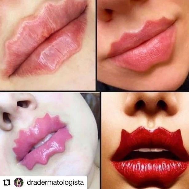 Devil lip fillers a new stupid trend? - 1