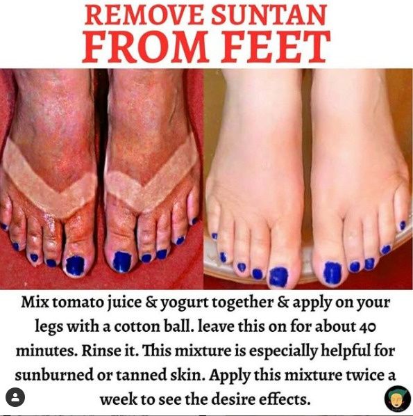Remove honeymoon tan lines from feet easy breezy! 1